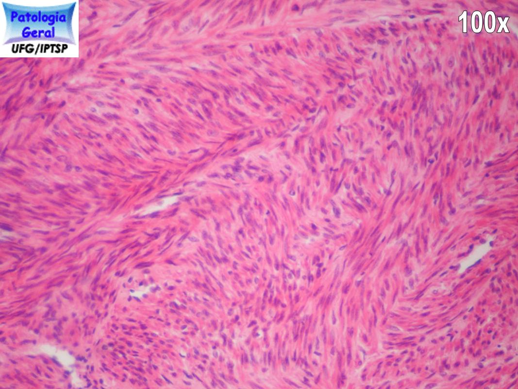 Leiomioma Iptsp Patologia